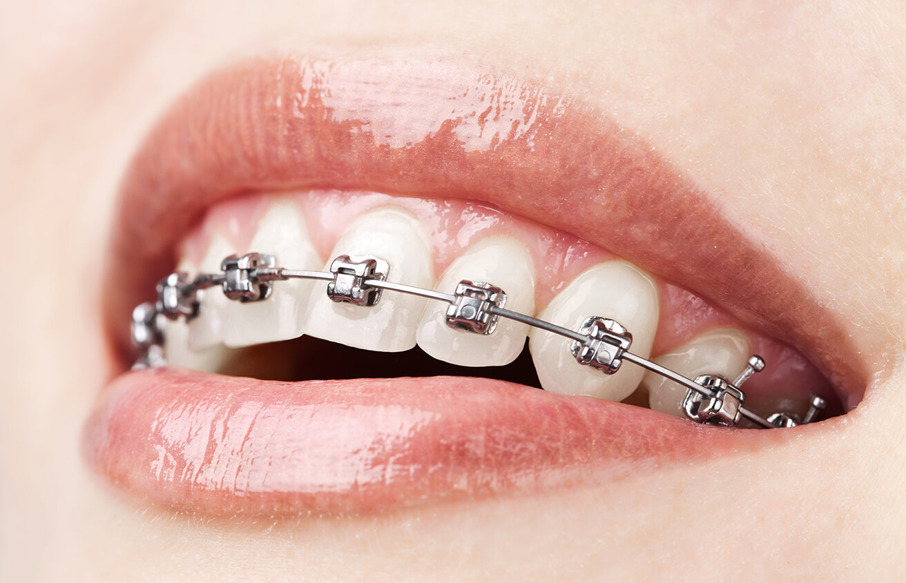 Fast Braces Treatment Time in Colorado Springs CO Area