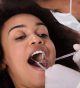 An Effective, Appealing Cavity Treatment with Composite Fillings