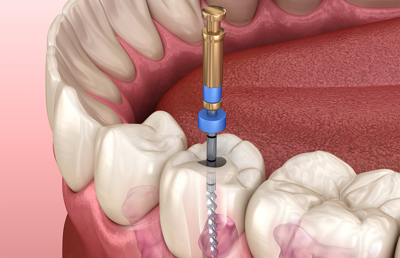 Root Canal Versus Extraction in Colorado Springs CO Area