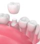 Broken Tooth? Make it Whole Again with Dental Crown Treatment