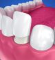 Unhappy with Your Smile? Change It for the Better with Porcelain Veneers