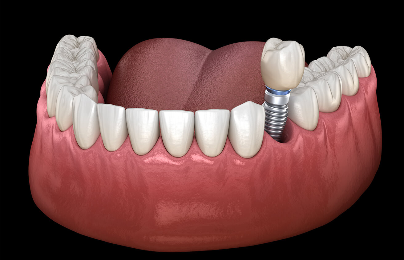 Single Tooth Dental Implants in Colorado Springs CO Area