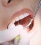 How composite resin cavity fillings provide non-toxic restoration of a natural tooth after tooth decay
