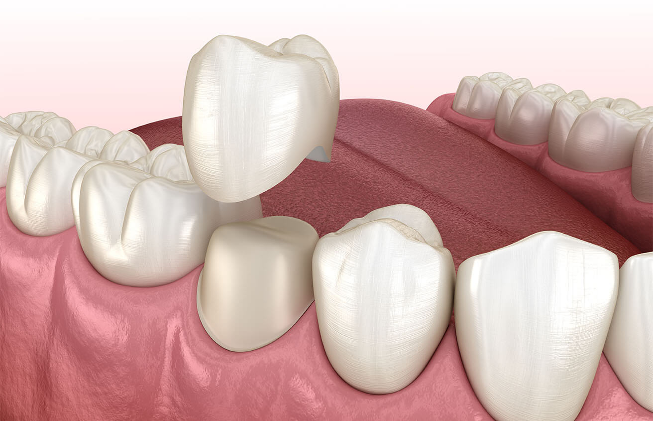 Dental Crown Replacement in Colorado Springs CO Area
