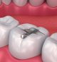 What are the advantages of composite dental fillings?