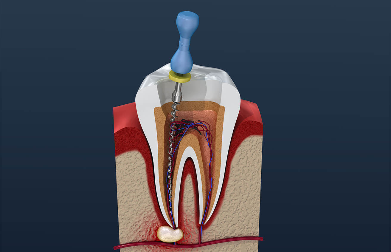 Signs of Root Canal Infection in Colorado Springs CO Area