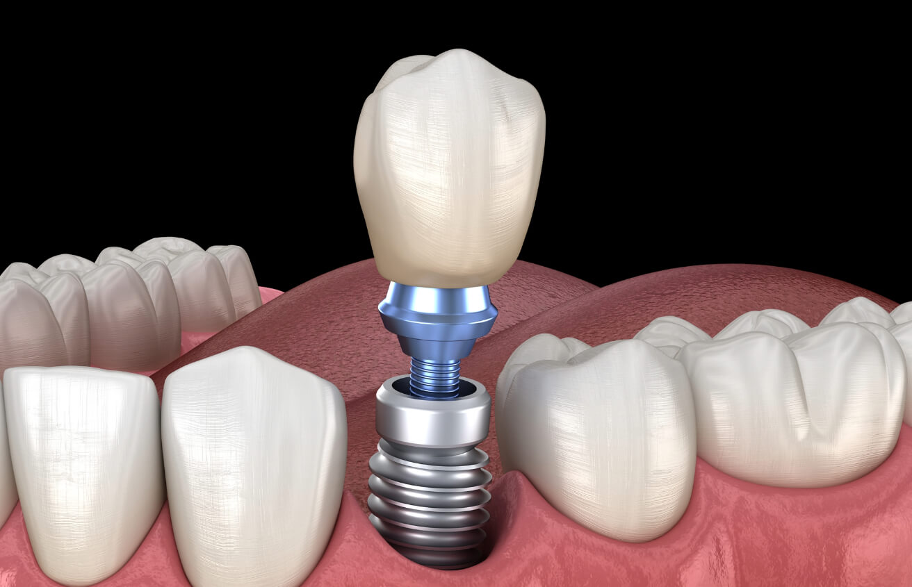 Dental Implants in Colorado Springs CO area