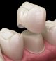 Where can I obtain CEREC same-day dental crowns and restorations?